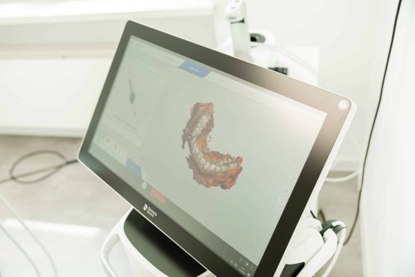 Digitaler Scan eines Unterkiefers auf dem Bildschirm
